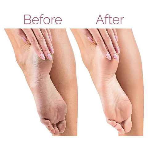 Electric Pedicure Foot File Callus Remover